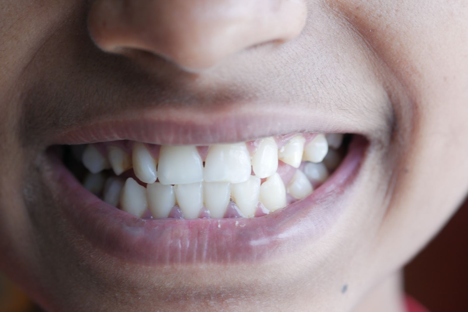 Close-up of a person's smile and teeth
